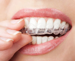 hand holding clear teeth aligners in mouth, Sterling, VA Invisalign, Chantilly, VA